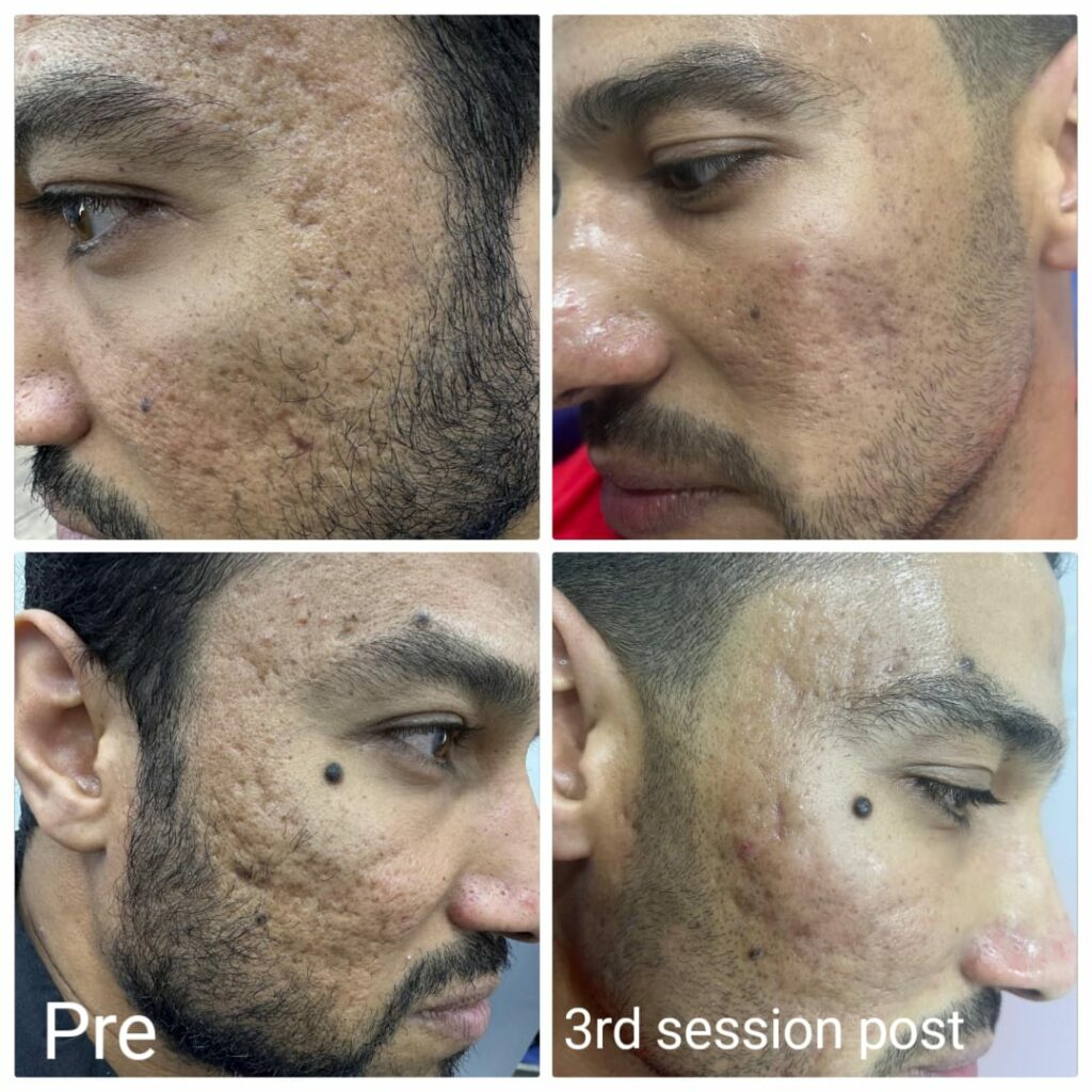 After three sessions of treatment for large pores